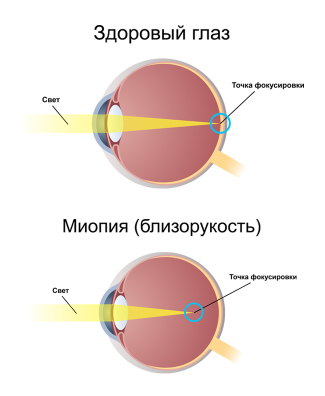 Как вылечить миопию у ребенка - коррекция миопии слабой степени