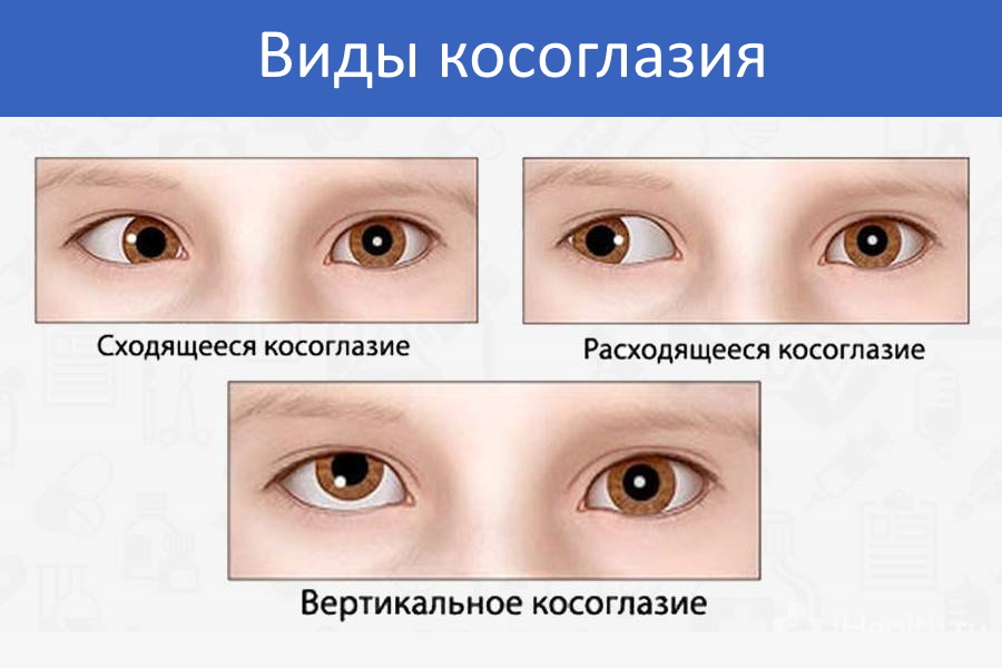 Какой глаз левый а какой правый. Сходящееся и расходящееся косоглазие. Соходашися комоглазие. Эзотропия сходящееся косоглазие. Расходящиеся косогдазие.