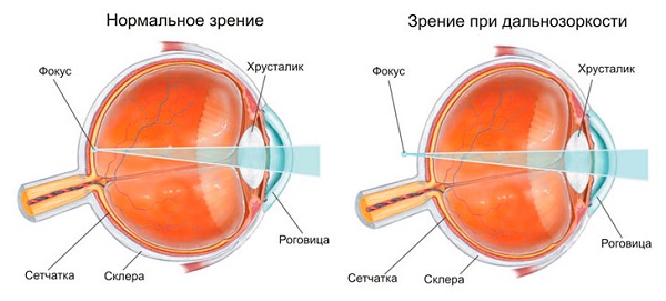 дальнозоркость - это плюс или минус