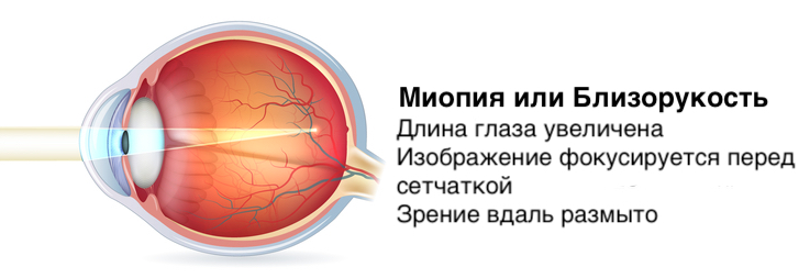 myopia