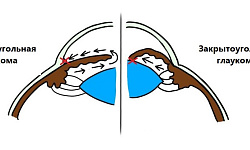 Закрытоугольная глаукома