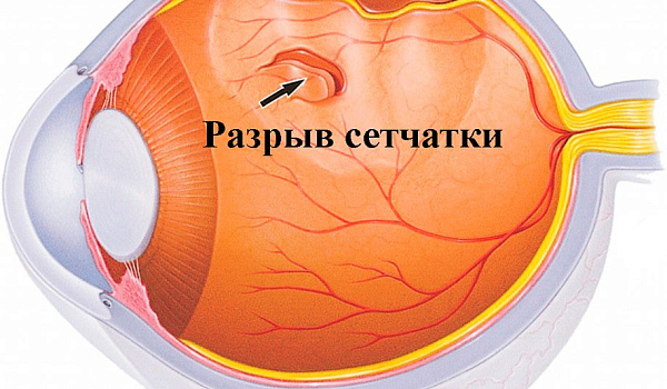 Атрофия сетчатки глаза с фото