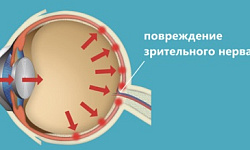 Глазное давление 40