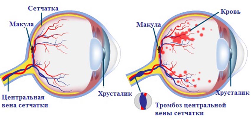 ::Desktop:сетчатка:Tromboz-tsentralnoy-venyi-setchatki.jpg