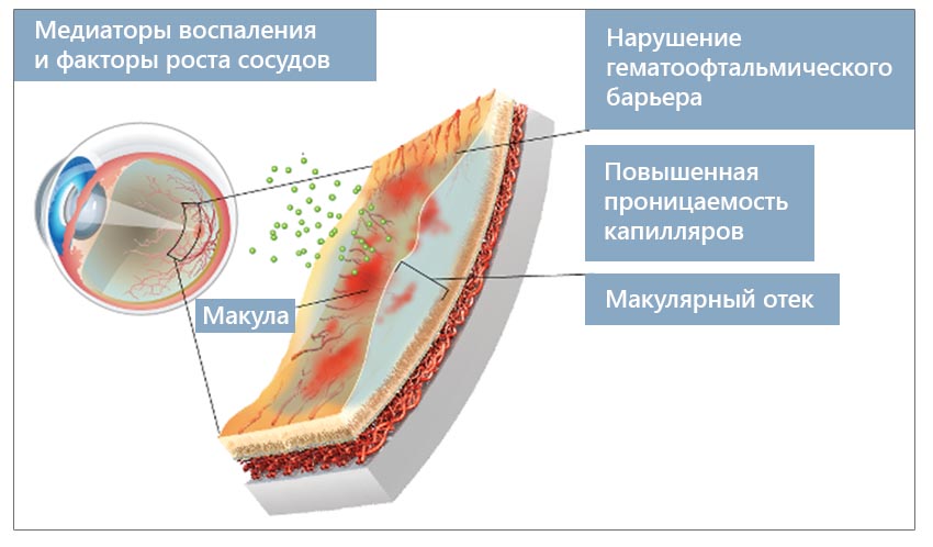 Где лечить заболевания сетчатки